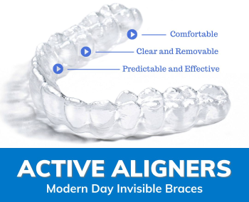 Active Aligners: Modern Day Invisible Braces